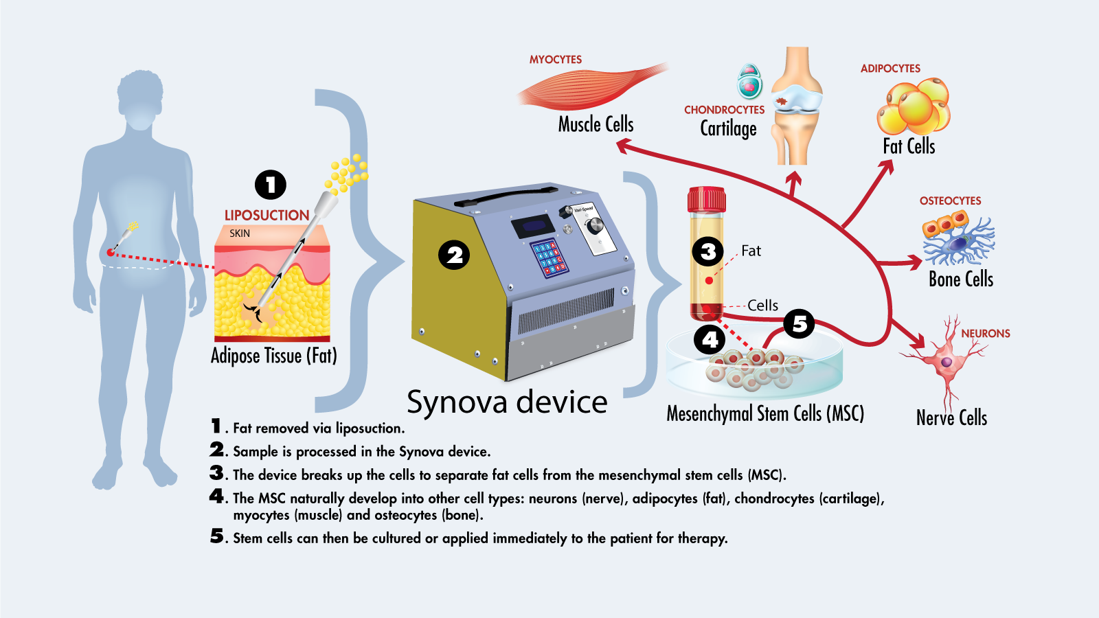 A diagram showcasing how the Synova device functions. A diagram showcasing how the Synova device works to produce stem cells from fat.